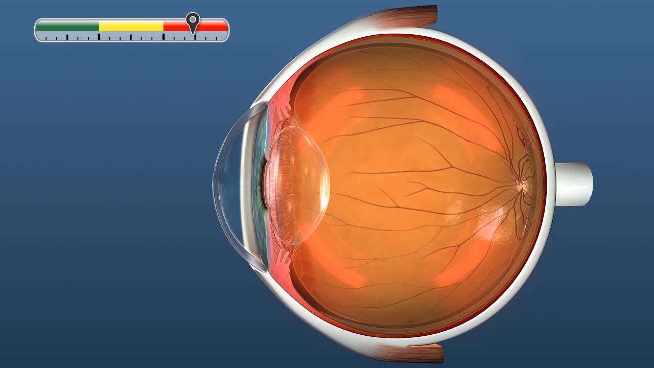 video glaucoma myopia)