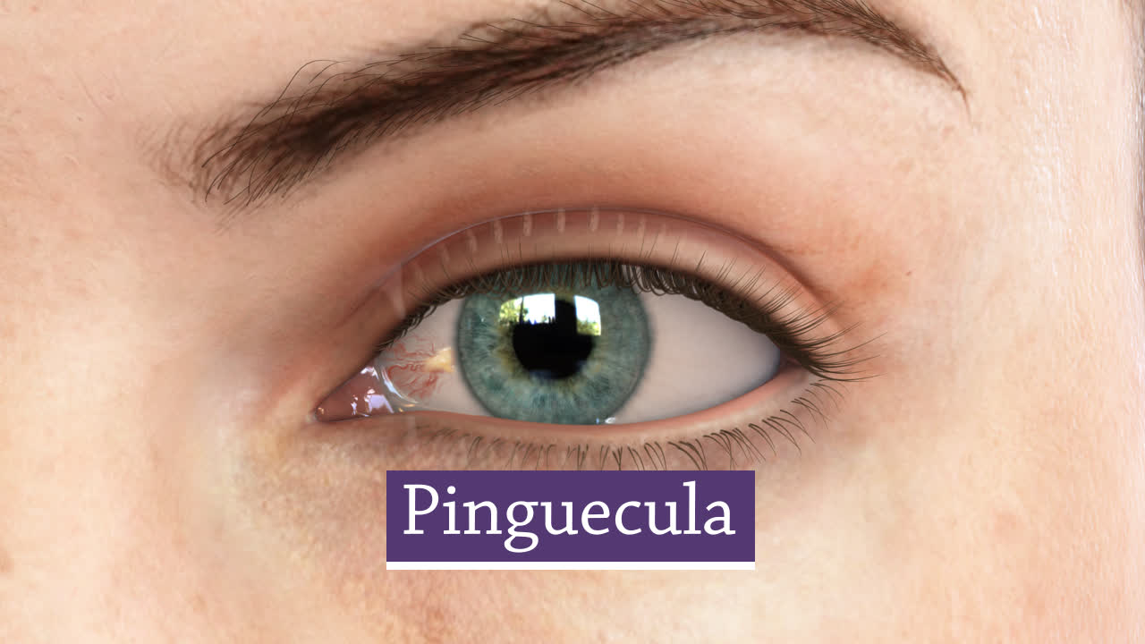 Panhandle Eye Group Llp Eye Disorders