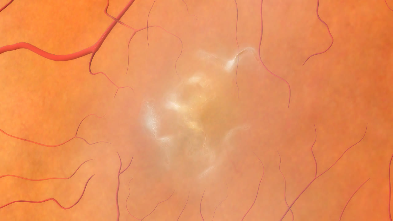 Puckering After Thread Lift Definition And Meaning In English MeaningKosh