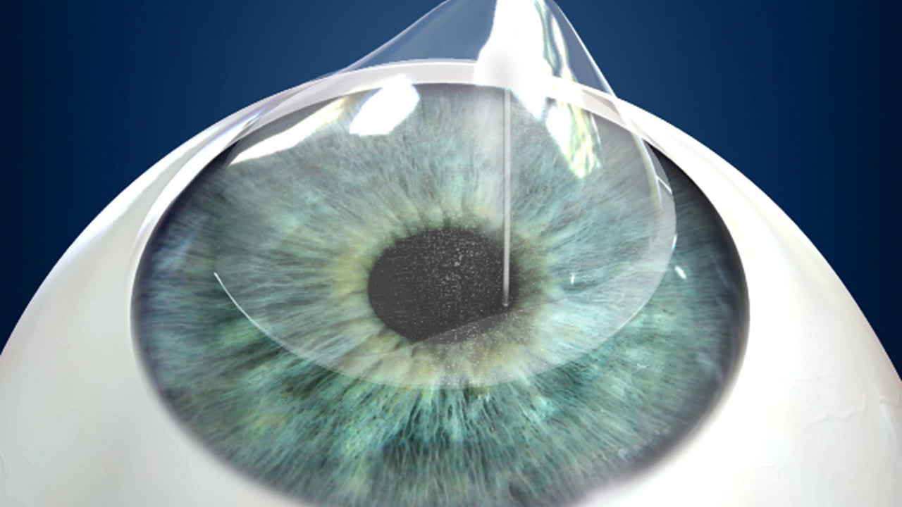 Lasik Eye Videos Eye Consultants Of Pennsylvania