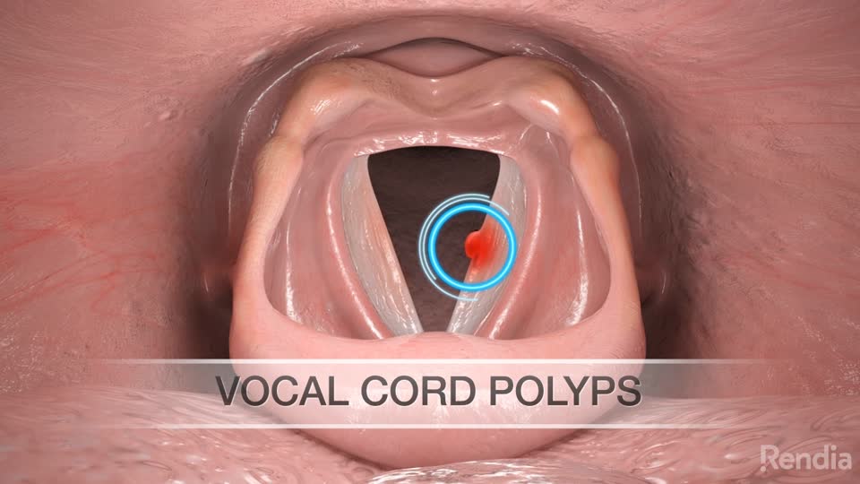 glutathione vocal polyps Cord Polyp - Vocal Cord Polyp Surgery Vocal Cord Nodules, Polyps, and