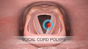 glutathione and vocal cord polyps Vocal Cord Nodules: Overview