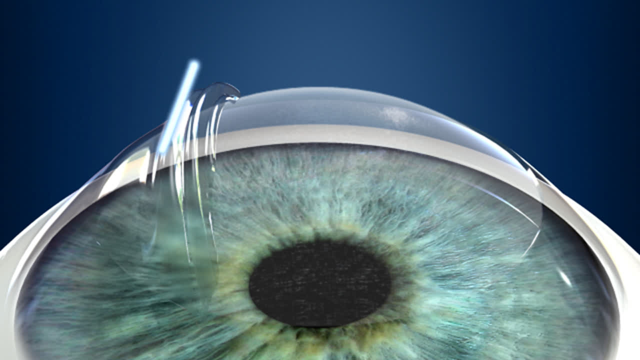 Lasik Eye Videos Eye Consultants Of Pennsylvania