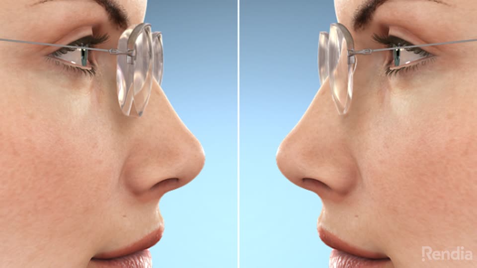 Hi Index Lenses Optometrist In Helena Mt Montana Eyecare